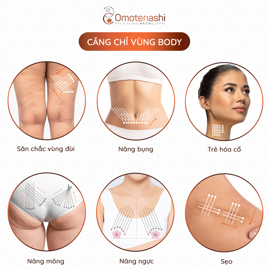 Các liệu trình căng chỉ vùng body